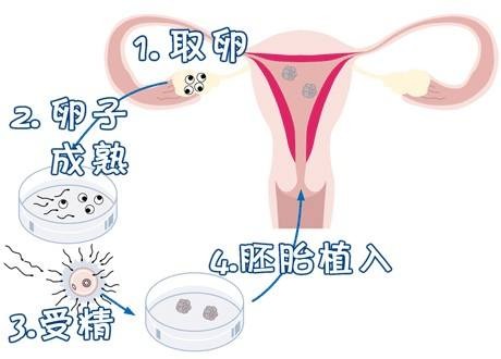 有偿孕妈借卵代怀咨询怎么选